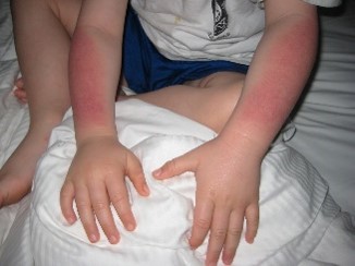 porphyria journey | Porphyria News | Brady's arms are red after a day in the sun. They were the first indication that something was wrong.