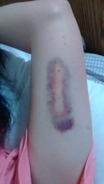 A woman's arm comes up from a pink T-shirt sleeve, revealing a large, vertical bruise on the inside of the arm. 