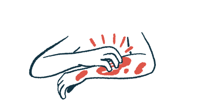 A hand scratches an arm with red spots on it.
