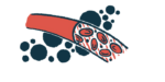 Illustration of blood cells moving through a blood vessel, representing blood pressure and cardiovascular changes in AIP.